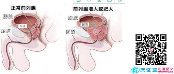 經(jīng)尿道前列腺等離子雙極電切術(shù)動畫視頻d.jpg