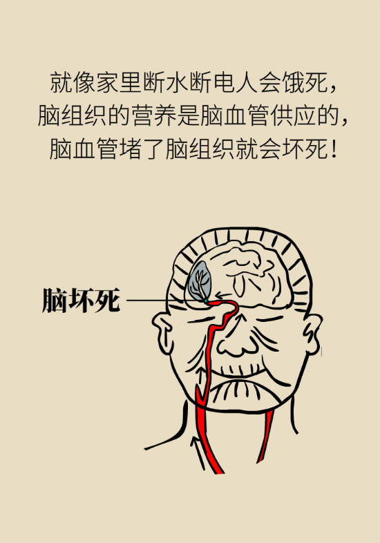 腔隙性腦梗死一定是腦血管堵了嗎？