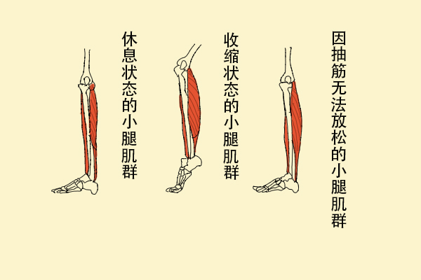 為什么缺鈣會(huì)導(dǎo)致抽筋？