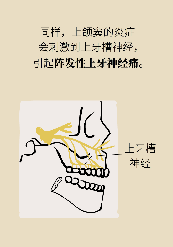 為什么鼻竇發(fā)炎，疼的卻是頭、眼和牙？