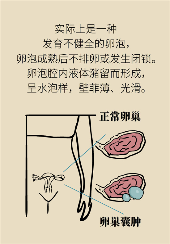 卵巢囊腫科普動(dòng)漫：卵巢囊腫是腫瘤嗎？要學(xué)會(huì)這樣區(qū)分