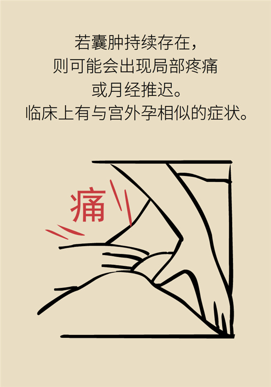 卵巢囊腫科普動(dòng)漫：卵巢囊腫是腫瘤嗎？要學(xué)會(huì)這樣區(qū)分