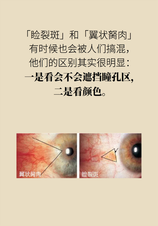 眼白有斑塊、出血要緊嗎？專家：名字唬人但問題不大