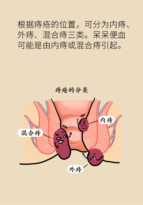 肛門腫脹還有血？小心痔瘡找上門