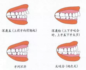 兒童換牙常見(jiàn)3大問(wèn)題，保護(hù)牙齒需要做好這5點(diǎn)