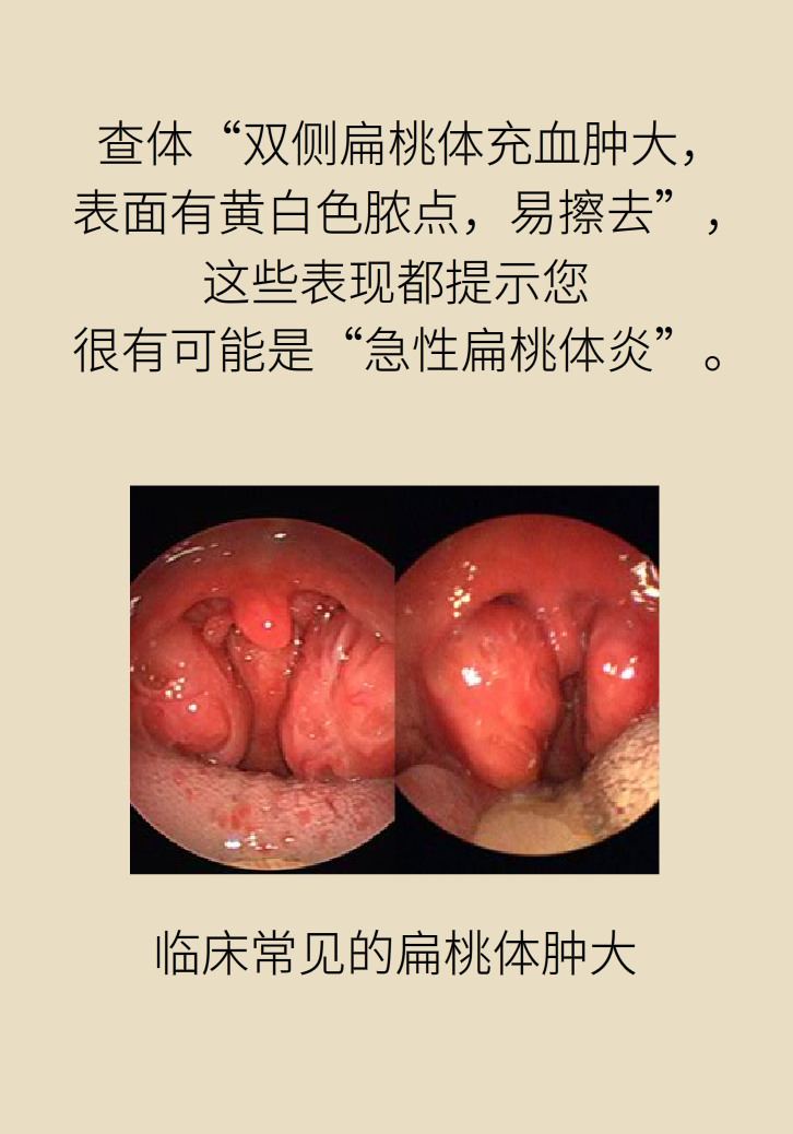 單側(cè)扁桃體腫大更兇險！謹防惡性腫瘤