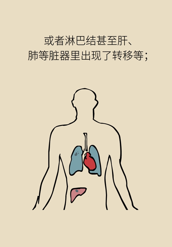 乳腺癌復(fù)發(fā)、轉(zhuǎn)移了怎么辦？