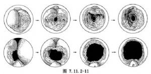 經尿道前列腺切除術